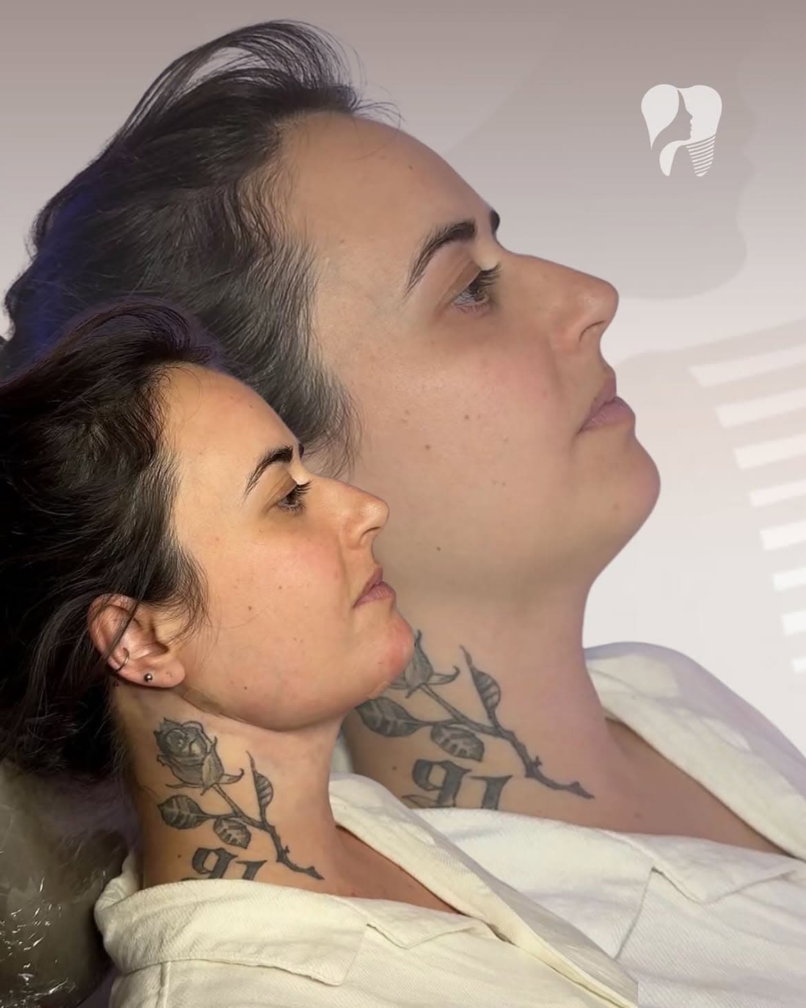 Resultado real de lipoaspiração de papada — caso 2