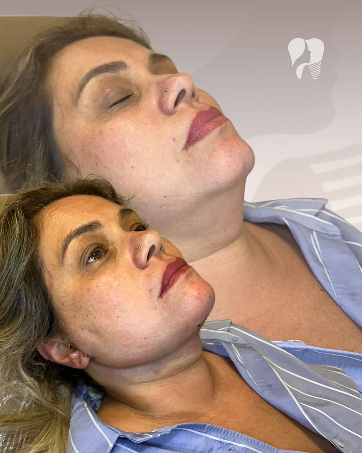 Resultado real de lipoaspiração de papada — caso 4