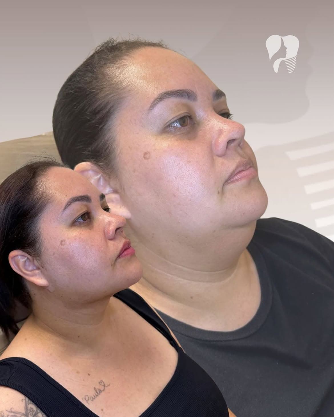Resultado real de lipoaspiração de papada — caso 5