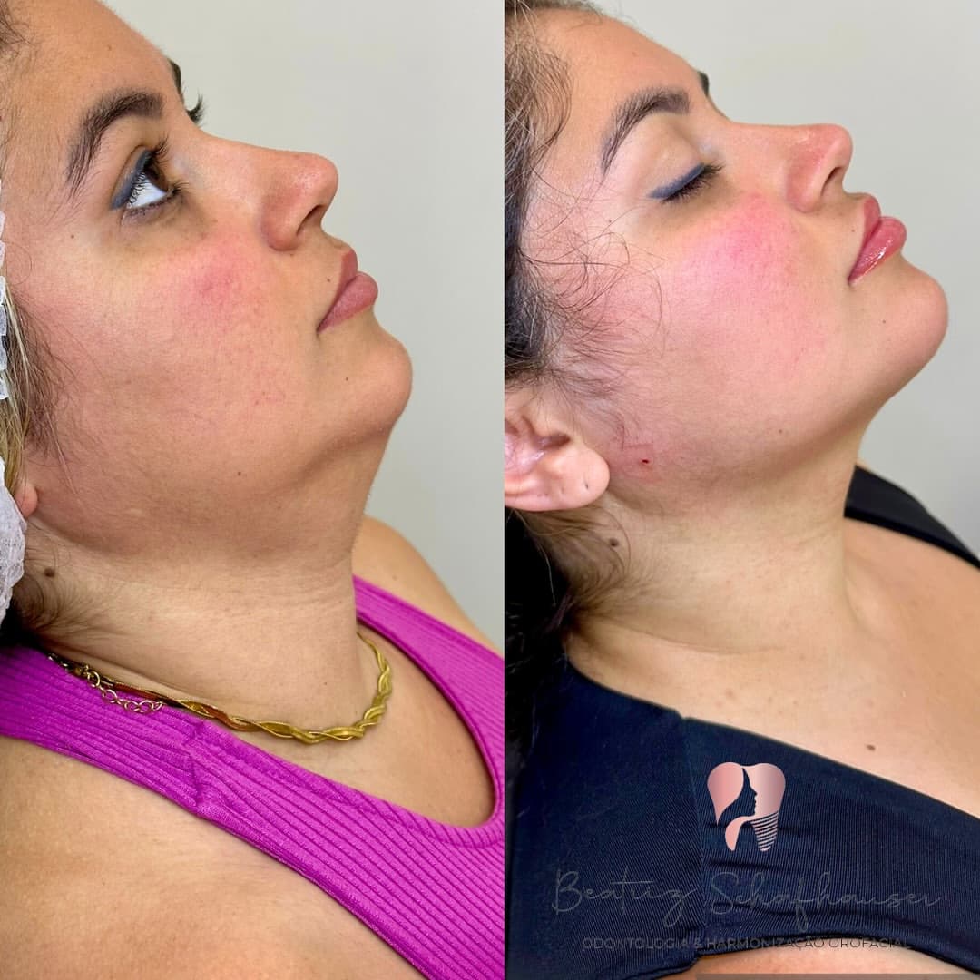 Resultado real de lipoaspiração de papada — caso 6